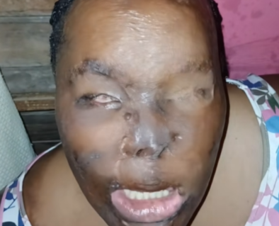 Help Charmaine after her ex-husband set her on fire — photo 2