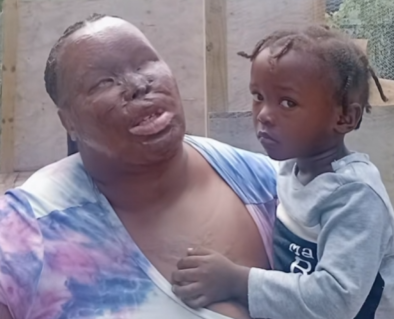 Help Charmaine after her ex-husband set her on fire — photo 3